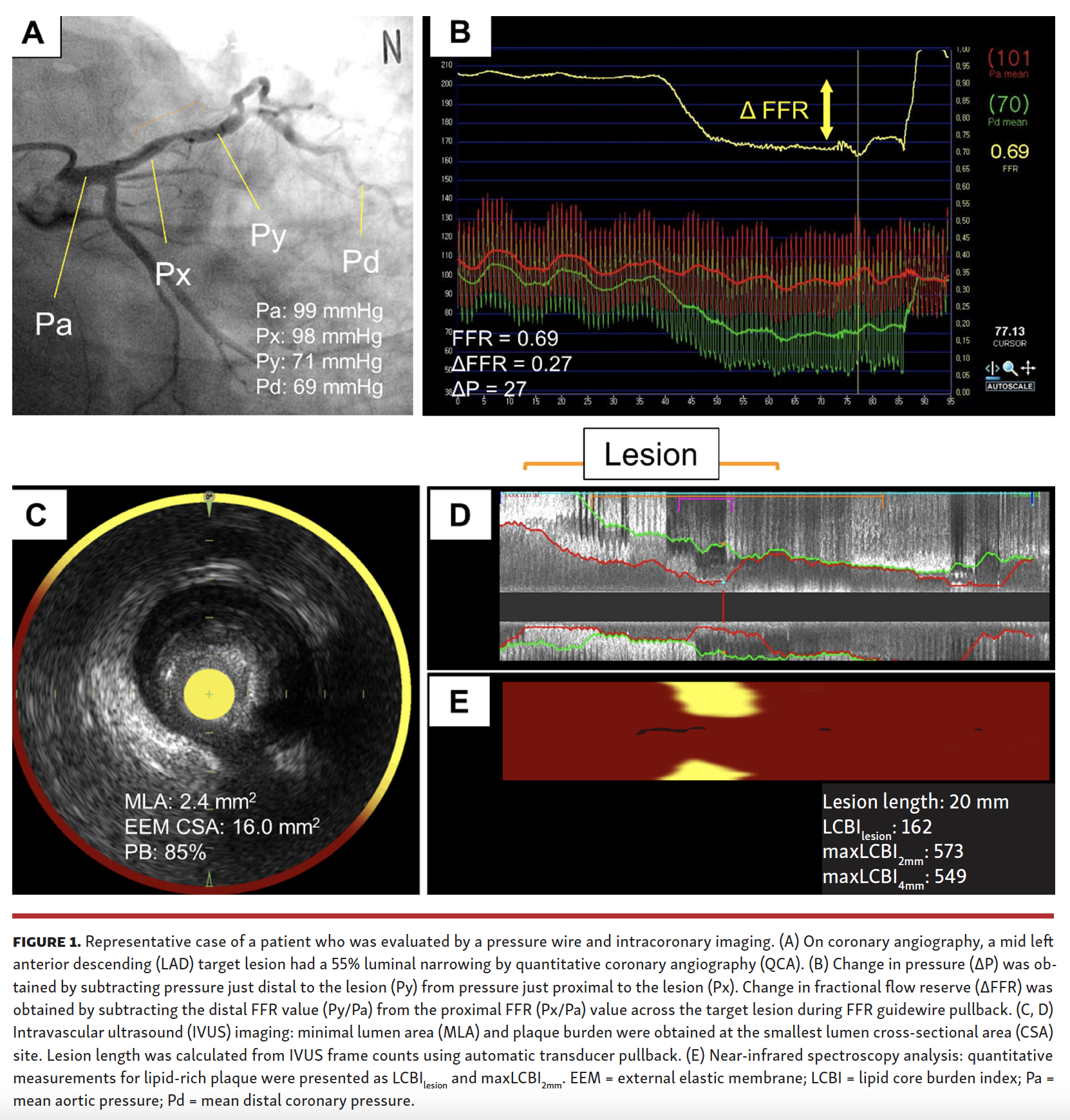 Fractional Flow Reserve & Plaque Components in Coronary